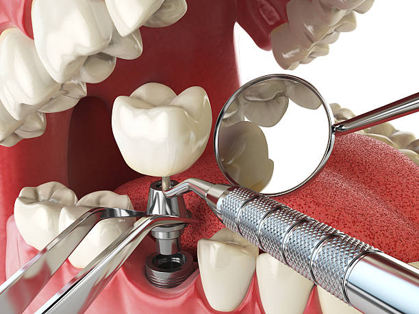 Best Emergency Dentist for Lost Fillings or Crowns in Flagstaff, AZ